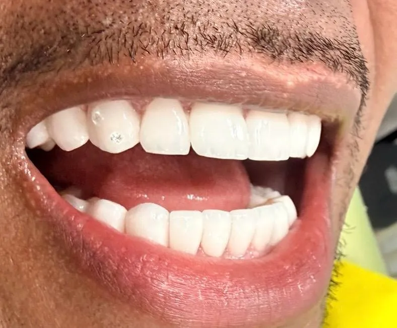 Resultado de un diseño de sonrisa realizado en RI Dental