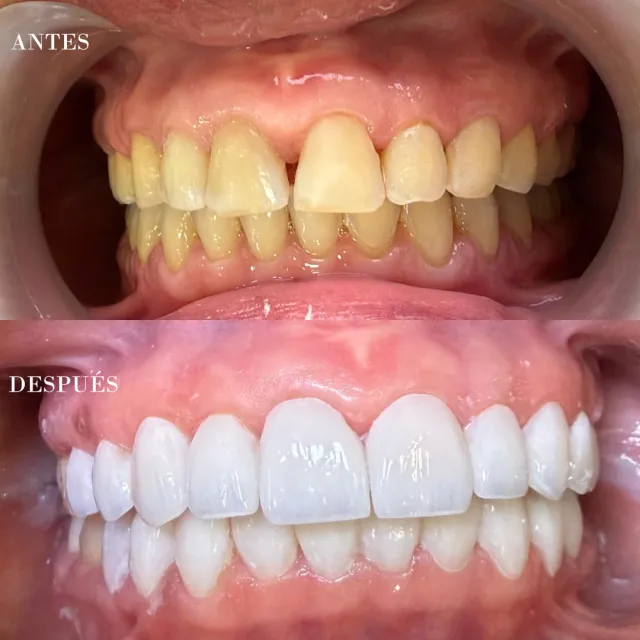 Antes y después de un diseño de sonrisa, caso 1