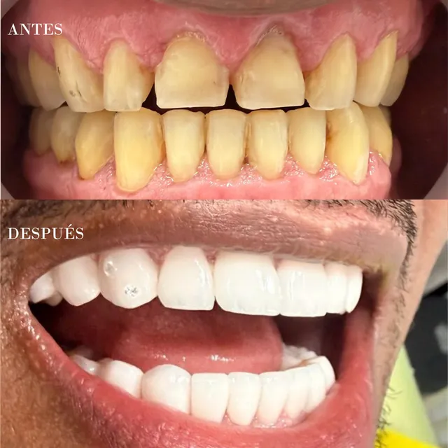 Antes y después de un diseño de sonrisa, caso 2