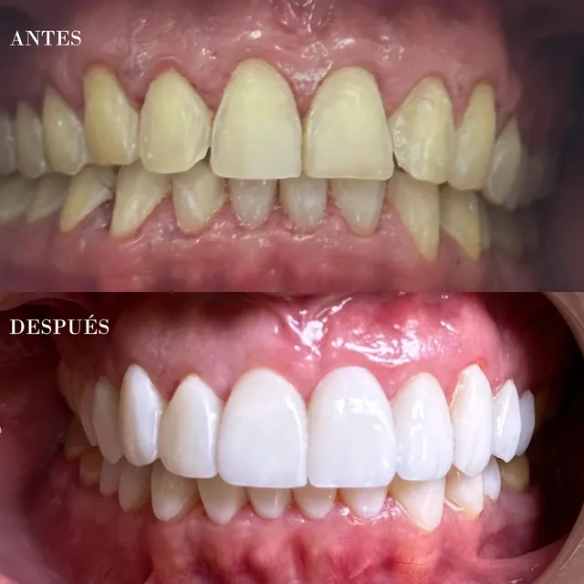 Antes y después de un diseño de sonrisa, caso 3