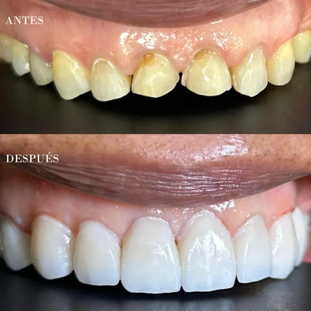 Antes y después de un diseño de sonrisa, caso 4